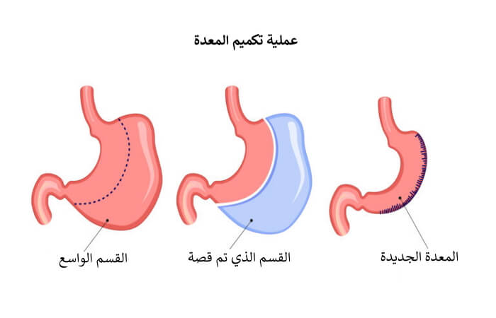 تجربتي مع الترهل بعد التكميم وكيفية علاجه