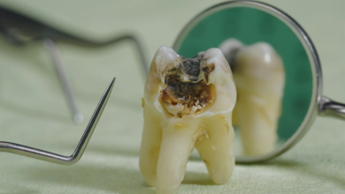 علاج تفتت الأسنان