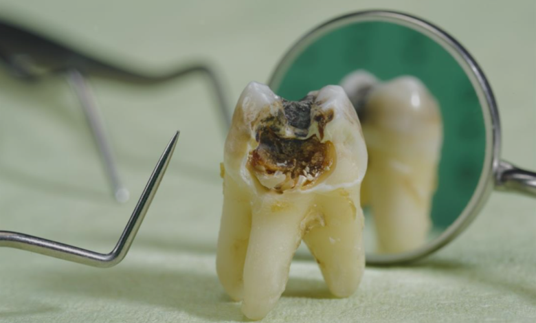 علاج تفتت الأسنان