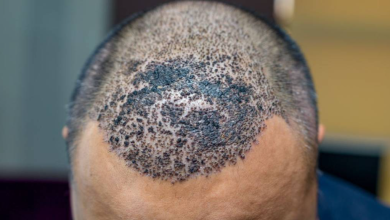 ما هي علامات نجاح عملية زراعة الشعر