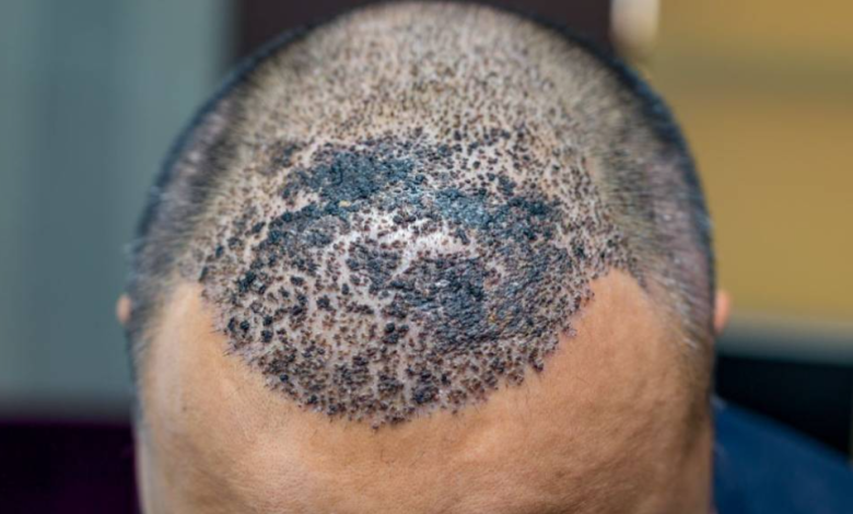 ما هي علامات نجاح عملية زراعة الشعر