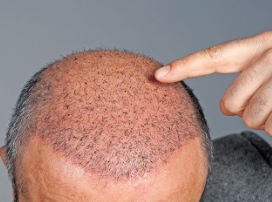 ما هي علامات نجاح عملية زراعة الشعر