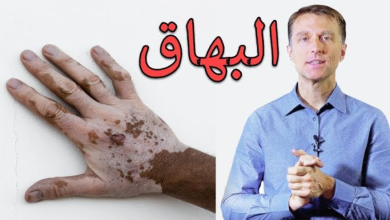 تجربتي للسيلينيوم لعلاج البهاق من المنزل