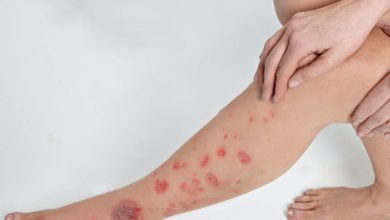 تحدث الحروق الكيميائية بسبب التعرض