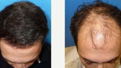 تجربتي مع زراعة الشعر باستخدام تقنية دي إتش آي